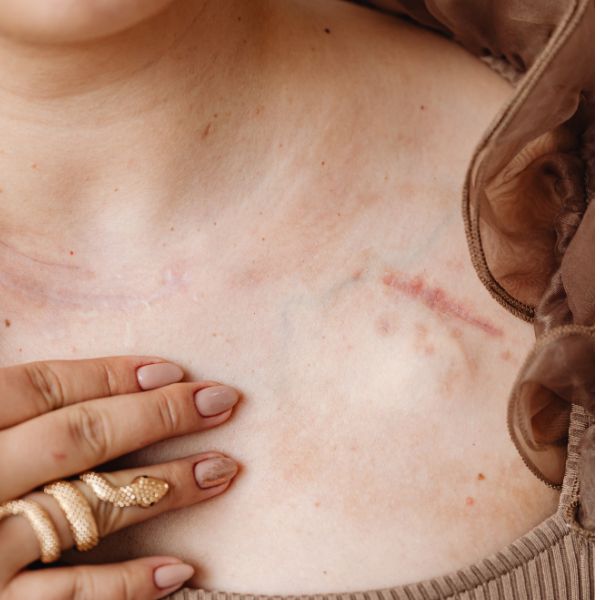 Hegkorrekció / hegkezelés