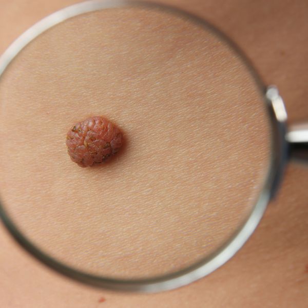 Anyajegy eltávolítás